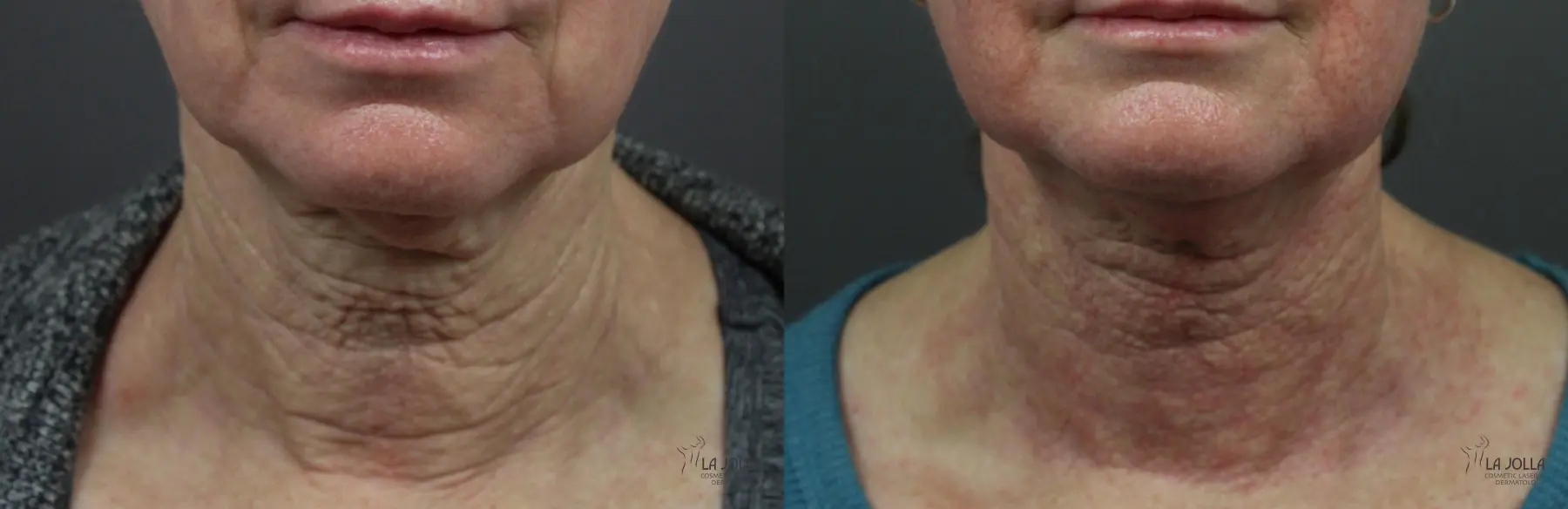 Non Surgical Neck Lift: Patient 4 - Before and After 2