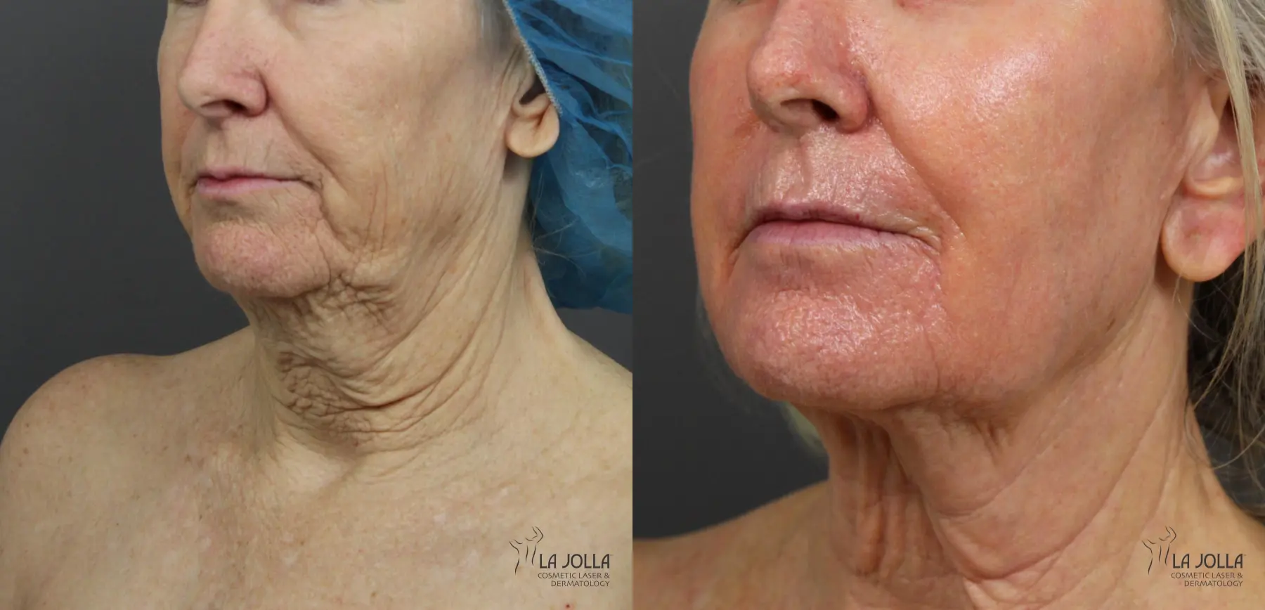 Non Surgical Neck Lift: Patient 3 - Before and After 2