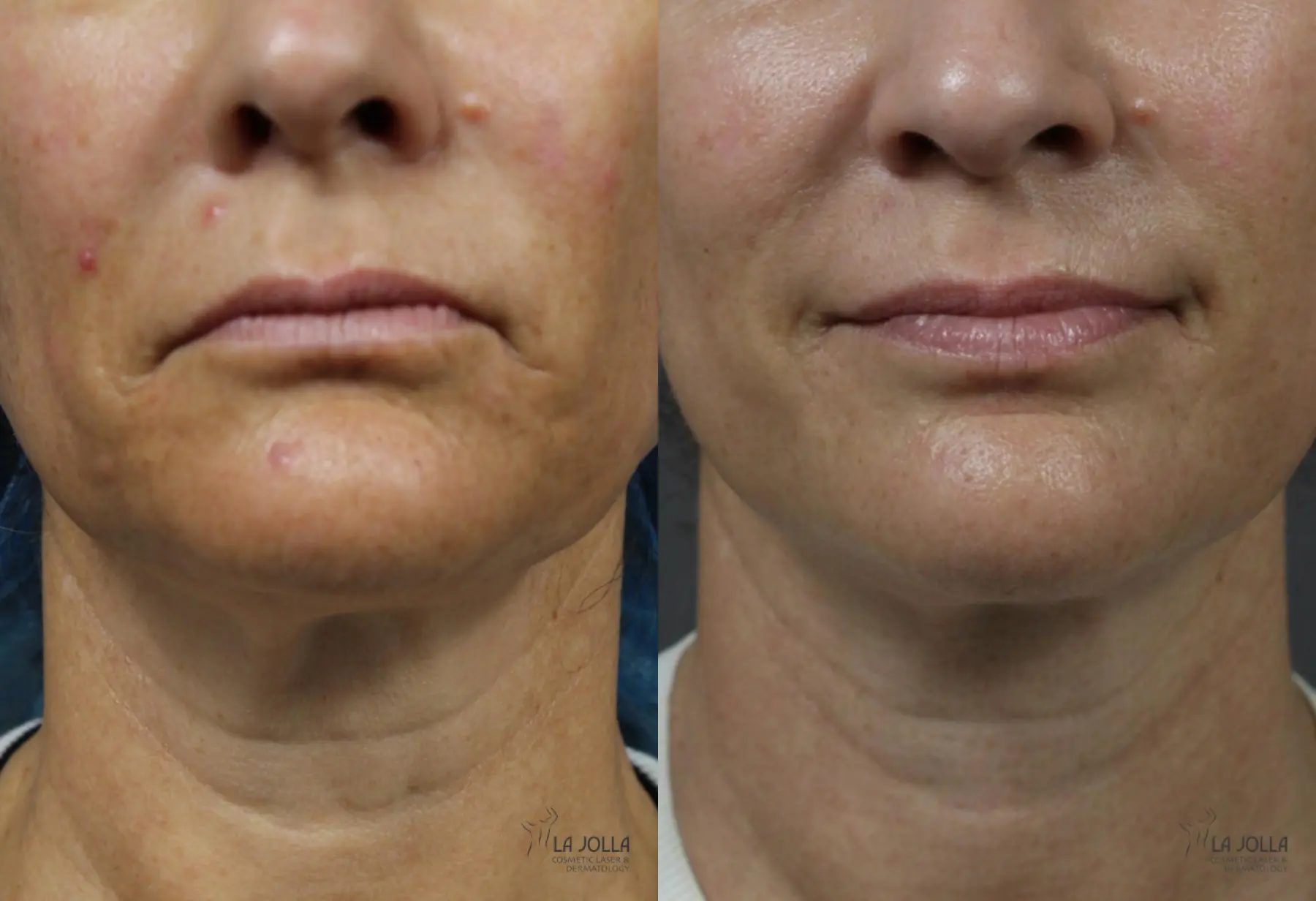 Non Surgical Neck Lift: Patient 7 - Before and After 1