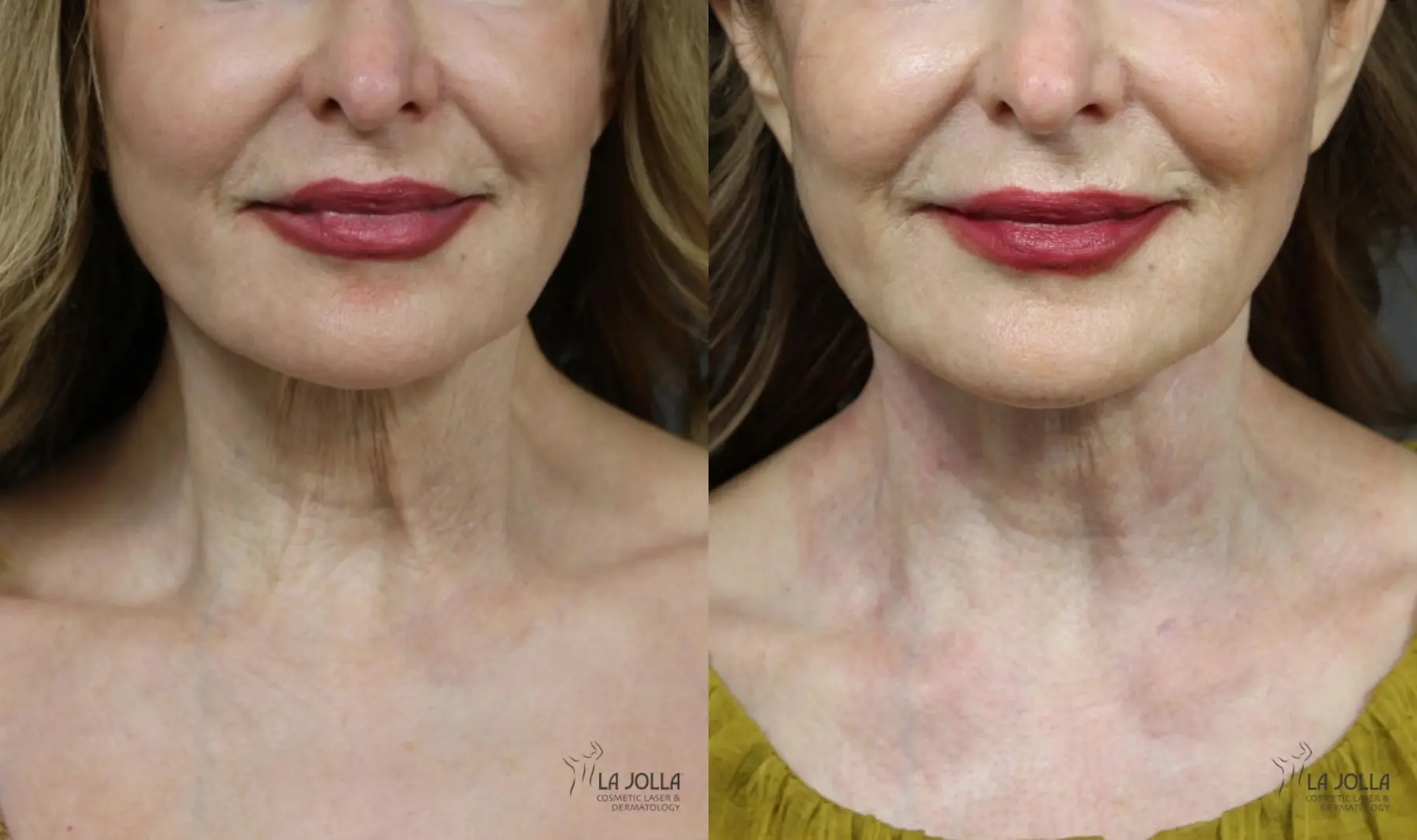 Non Surgical Neck Lift: Patient 1 - Before and After  