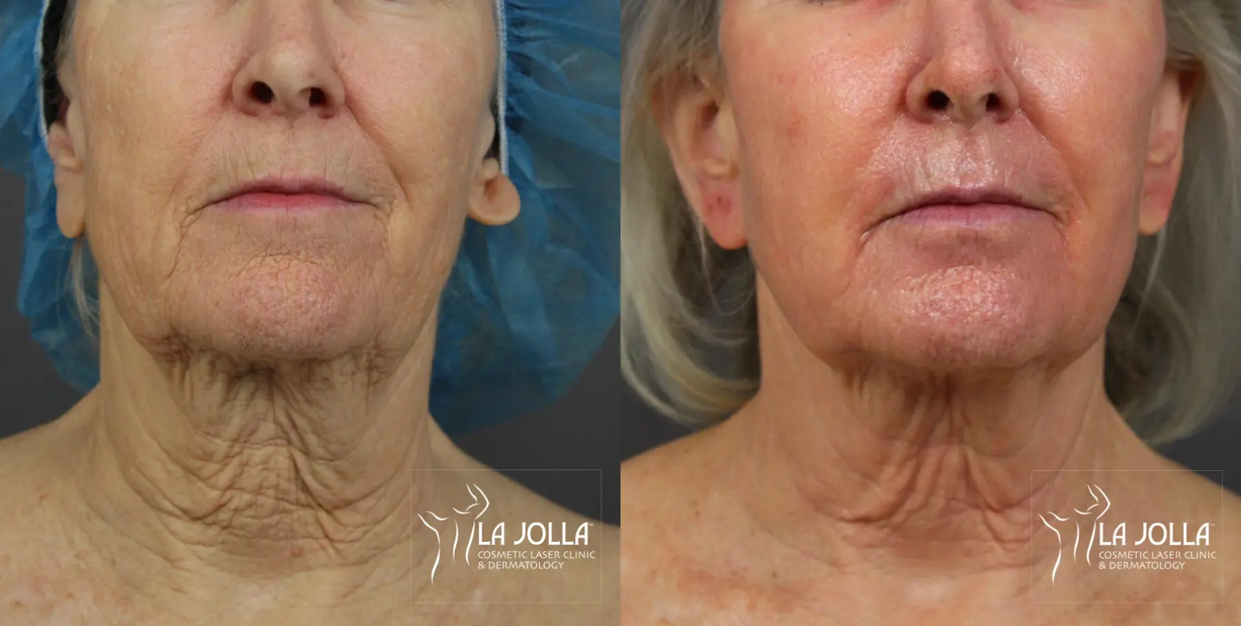 Non Surgical Neck Lift: Patient 3 - Before and After 1