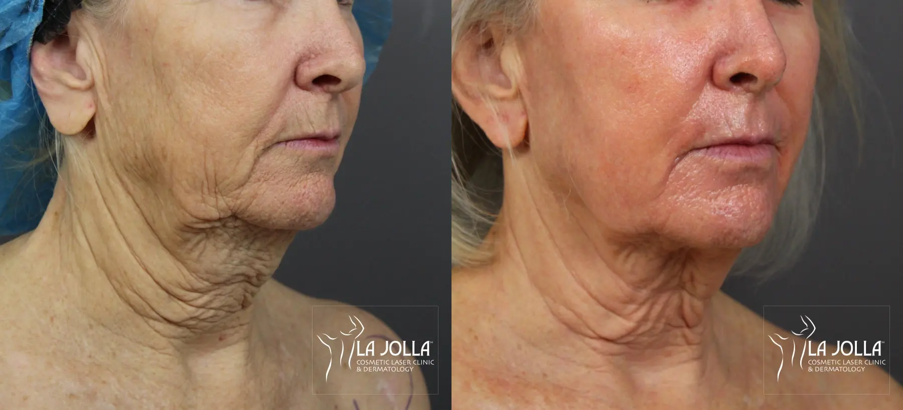 Non Surgical Neck Lift: Patient 3 - Before and After 3