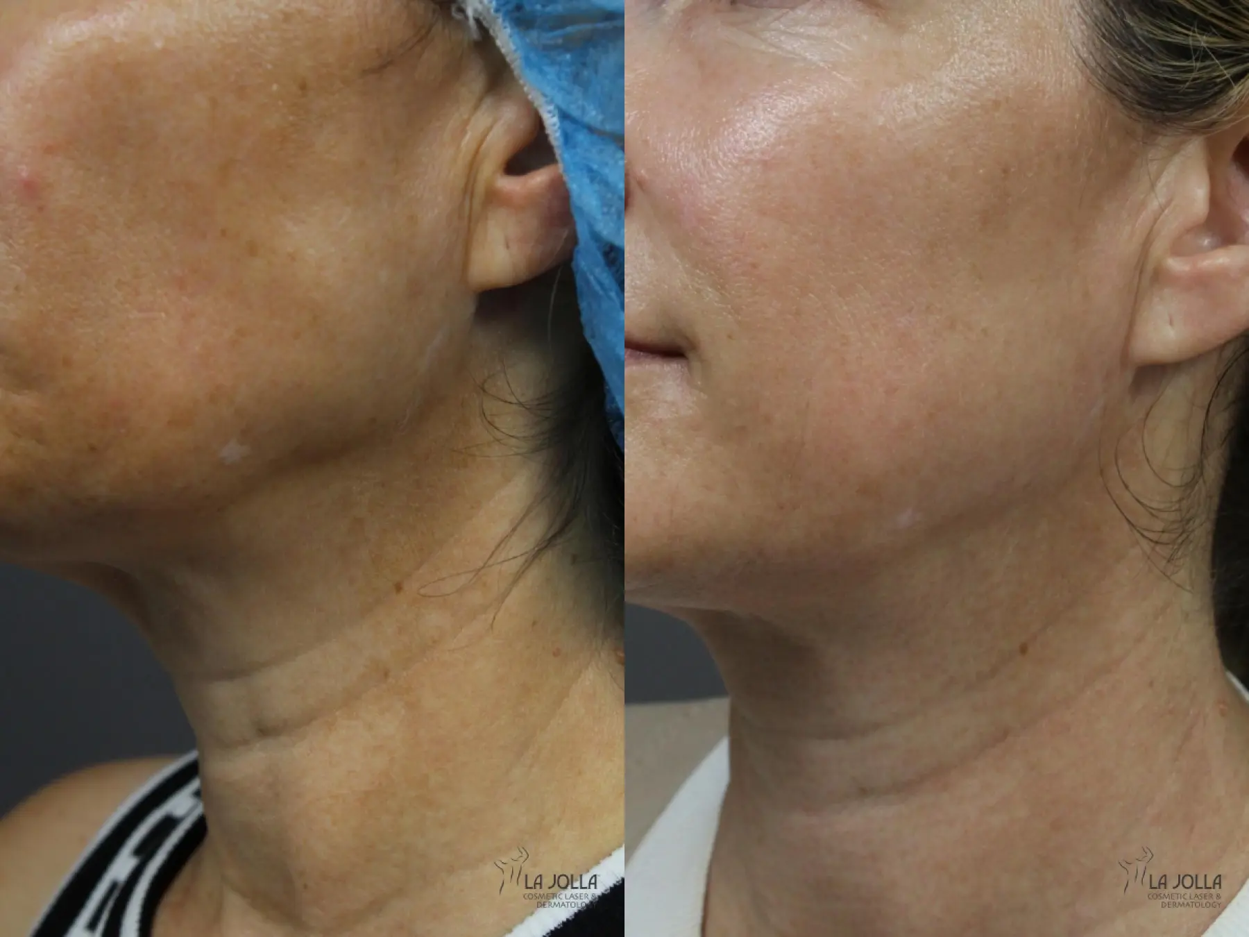 Non Surgical Neck Lift: Patient 7 - Before and After 2