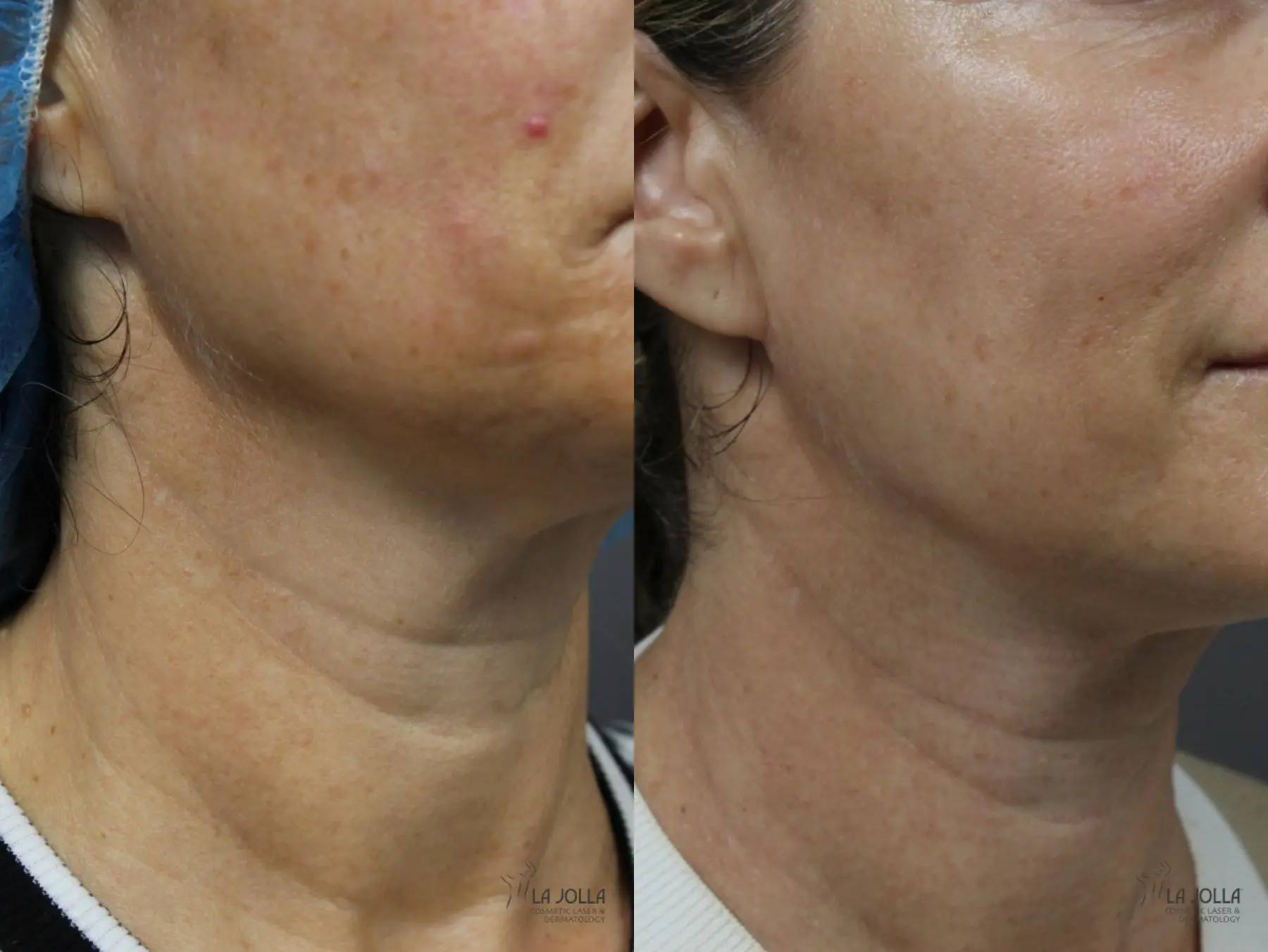 Non Surgical Neck Lift: Patient 7 - Before and After 3