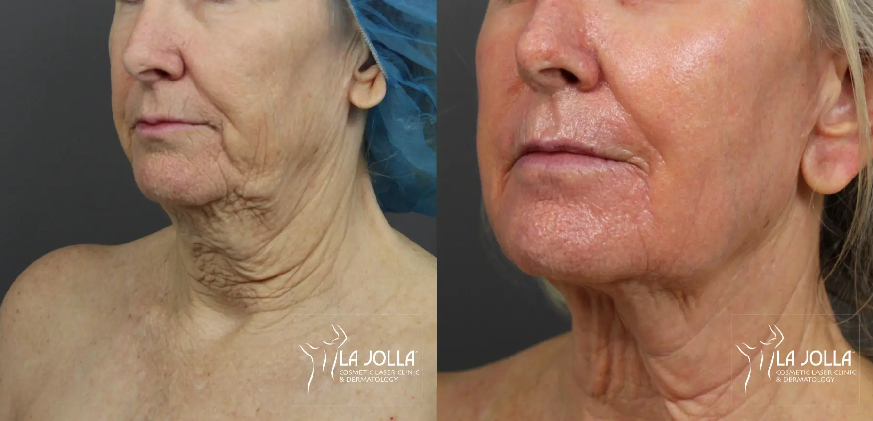 Non Surgical Neck Lift: Patient 3 - Before and After 2
