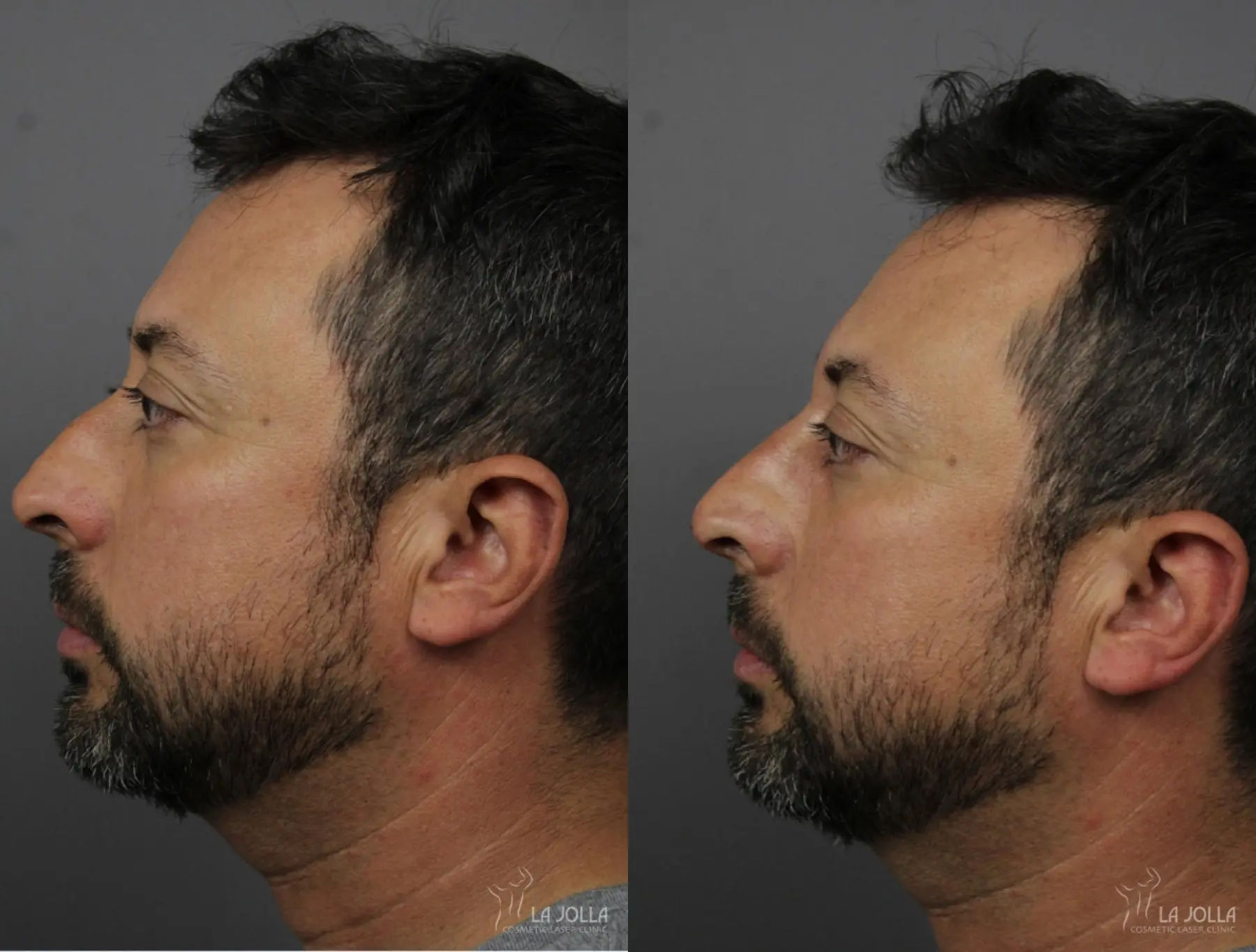 Nose Filler: Patient 3 - Before and After  