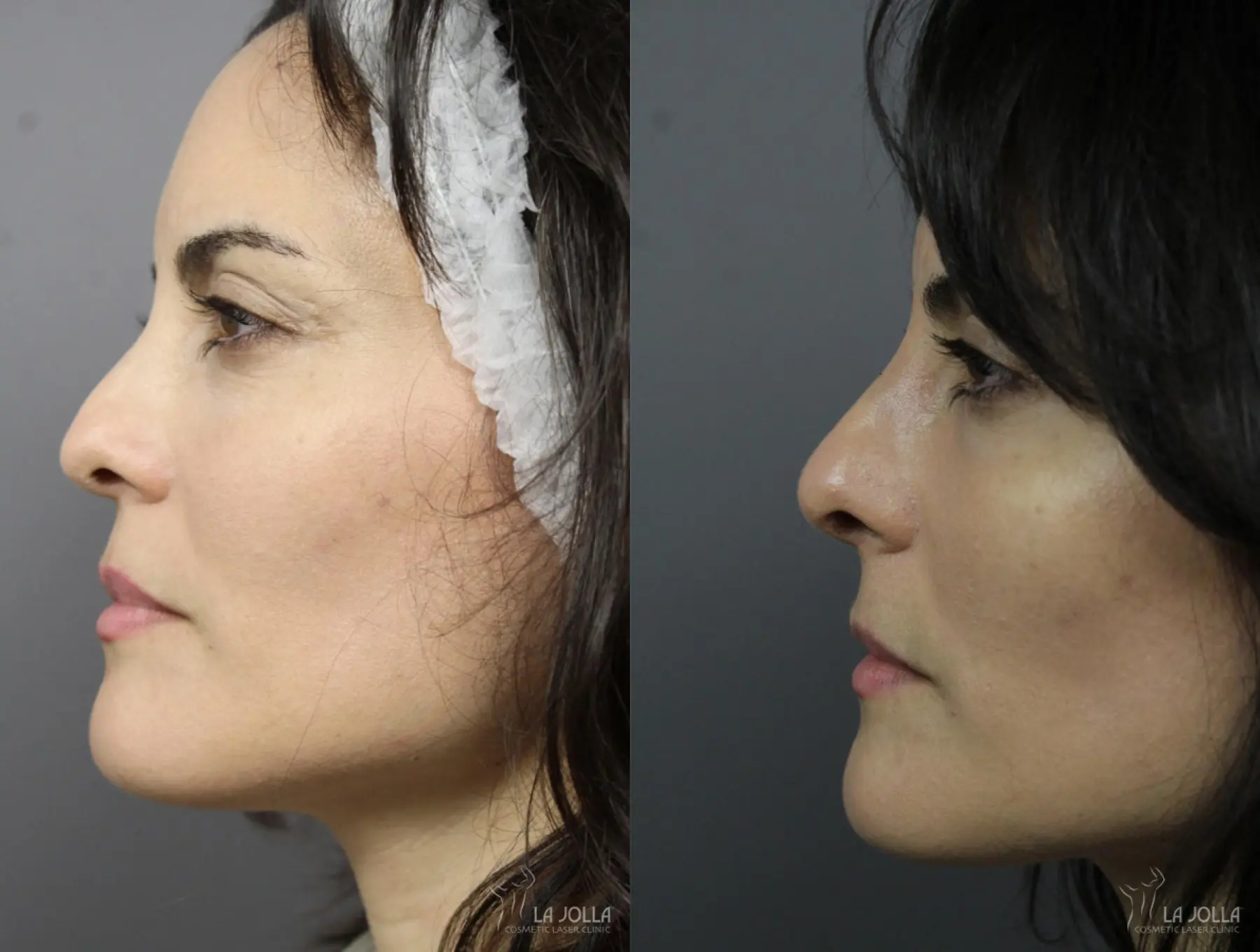 Nose Filler: Patient 4 - Before and After 1