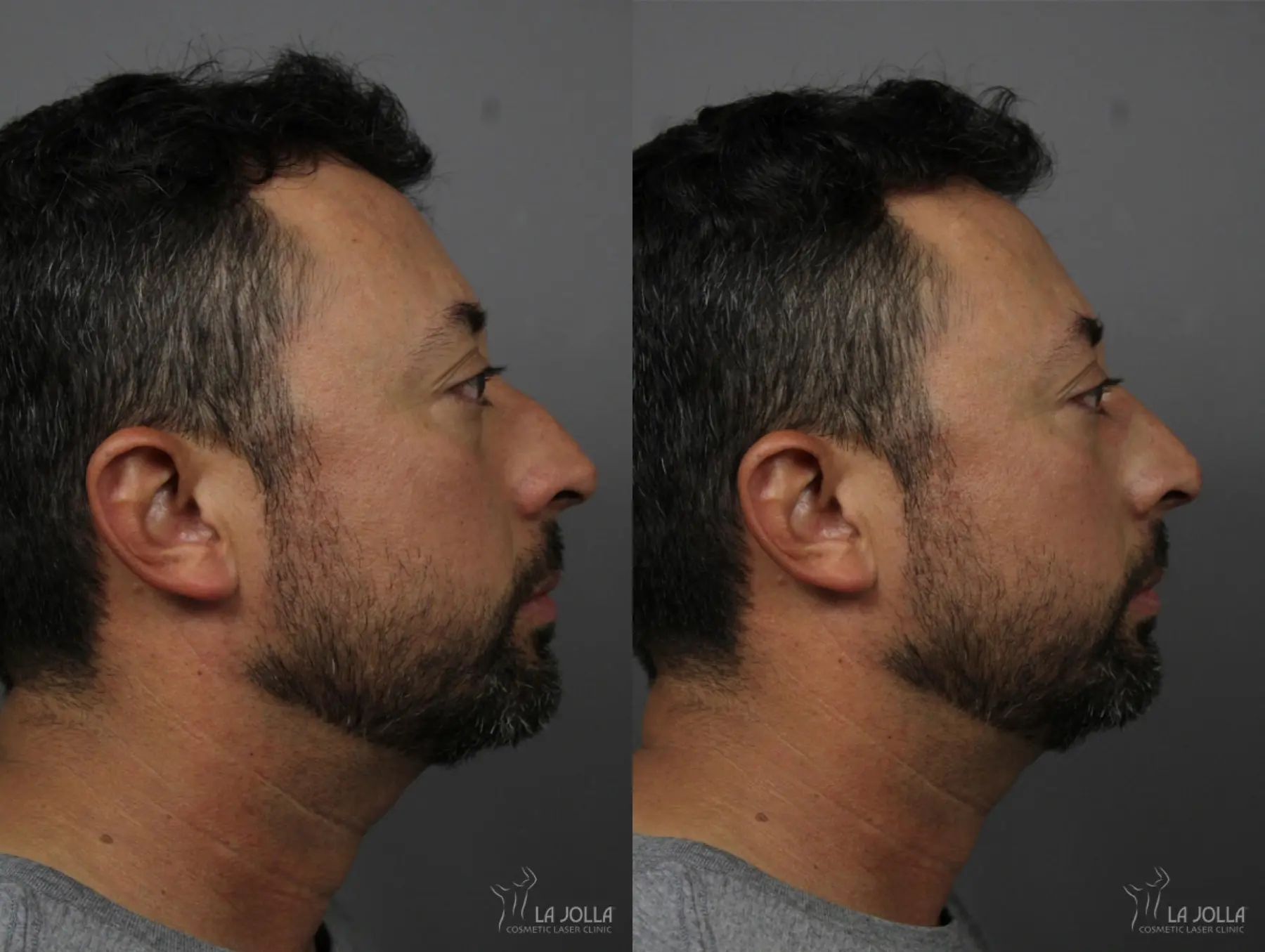 Nose Filler: Patient 3 - Before and After 2