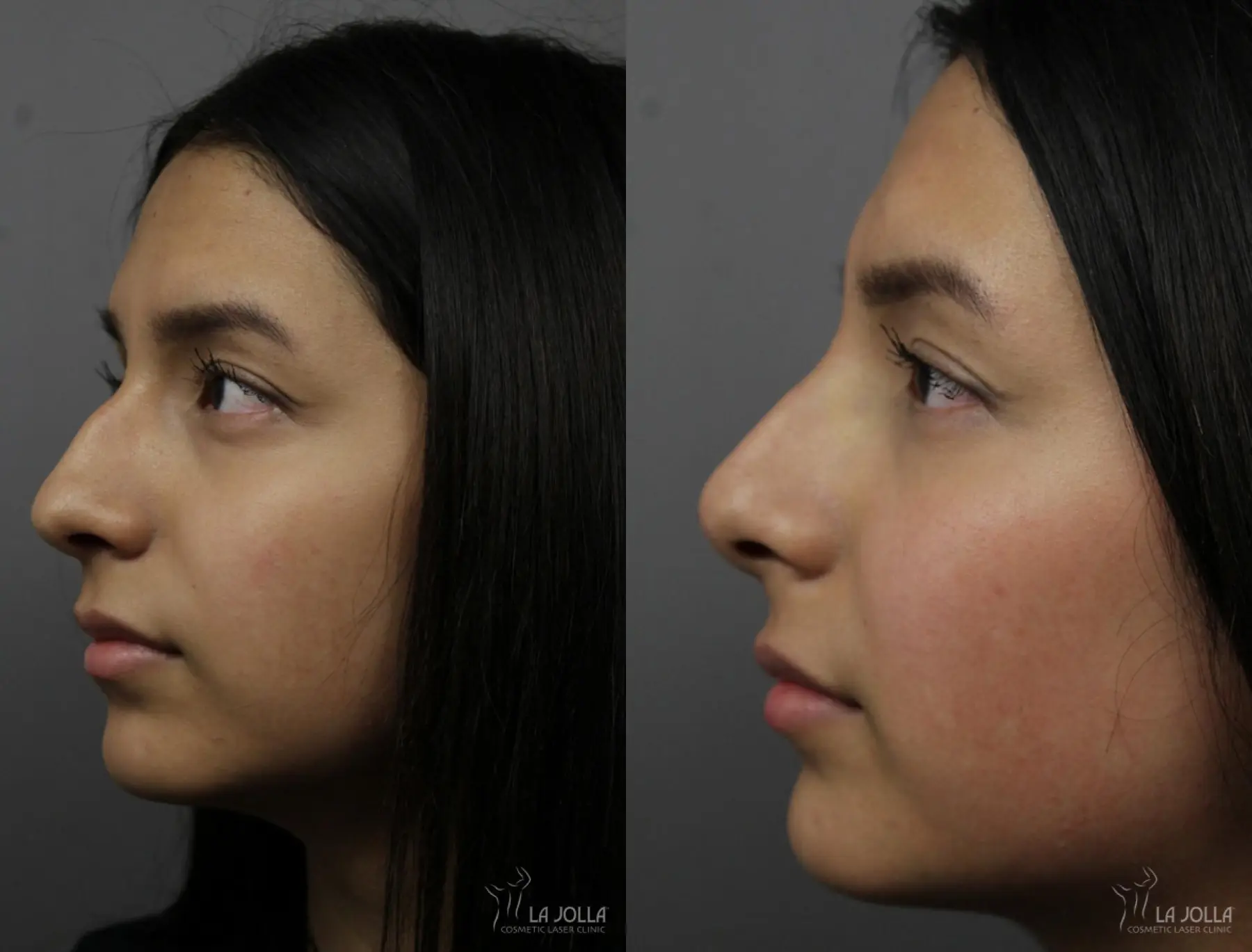 Nose Filler: Patient 5 - Before and After  