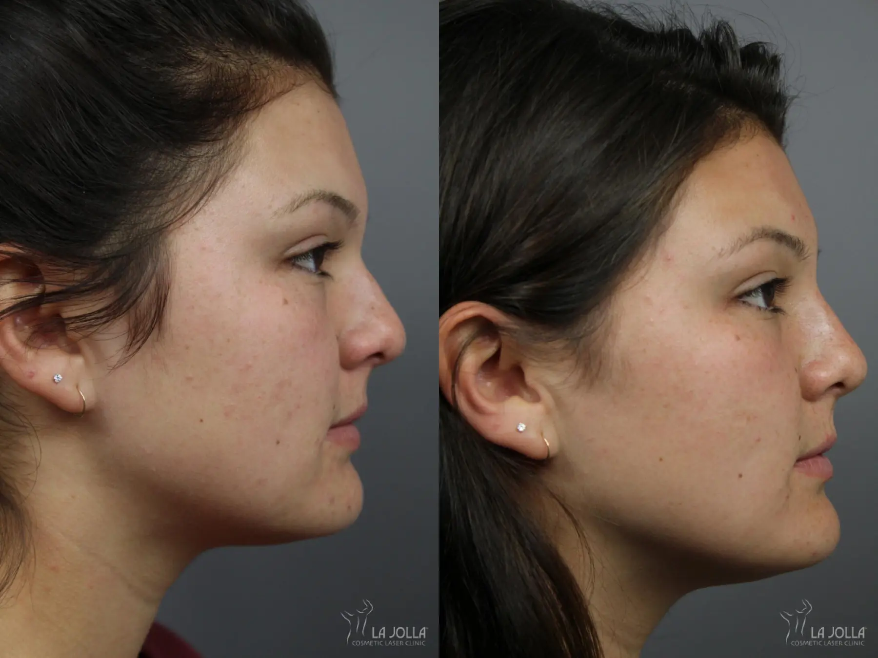 Nose Filler: Patient 7 - Before and After 1