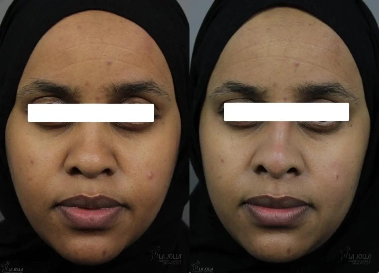 Nose Filler: Patient 1 - Before and After 1