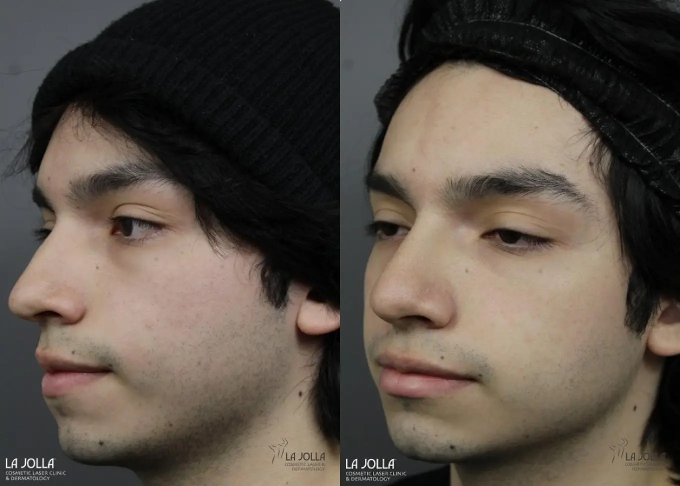 Nose Filler: Patient 2 - Before and After 2