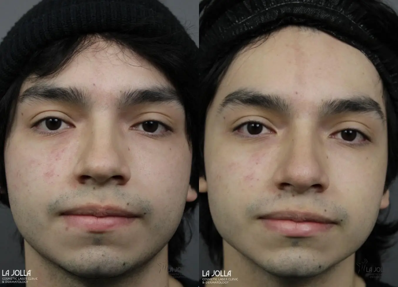 Nose Filler: Patient 2 - Before and After 1
