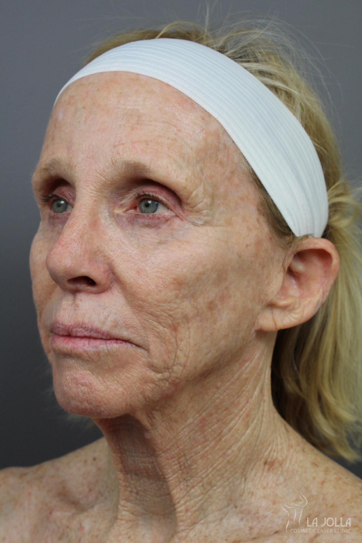 SP Dynamis: Patient 44 - Before 1