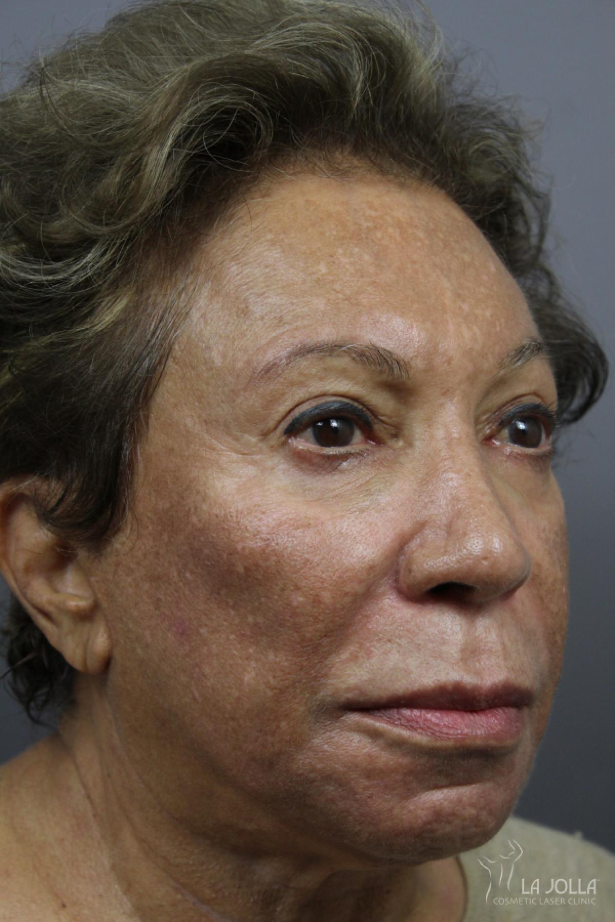 Chemical Peel: Patient 4 - Before 1