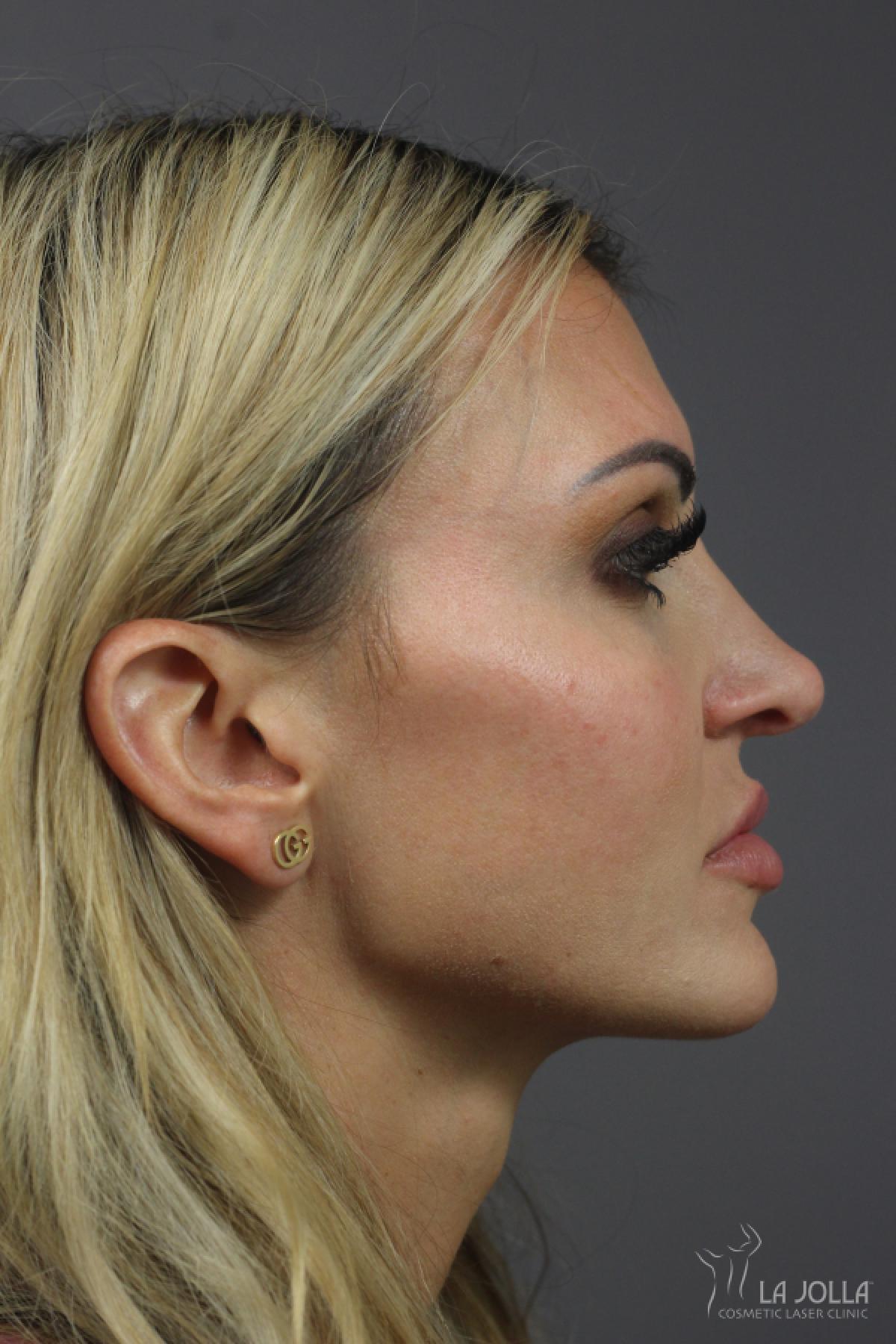 Nose Filler: Patient 6 - Before 
