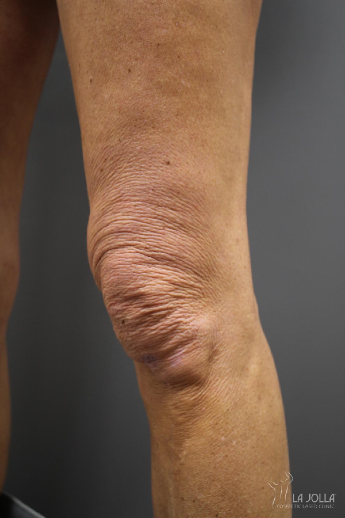 StarWalker® Laser: Patient 7 - Before 