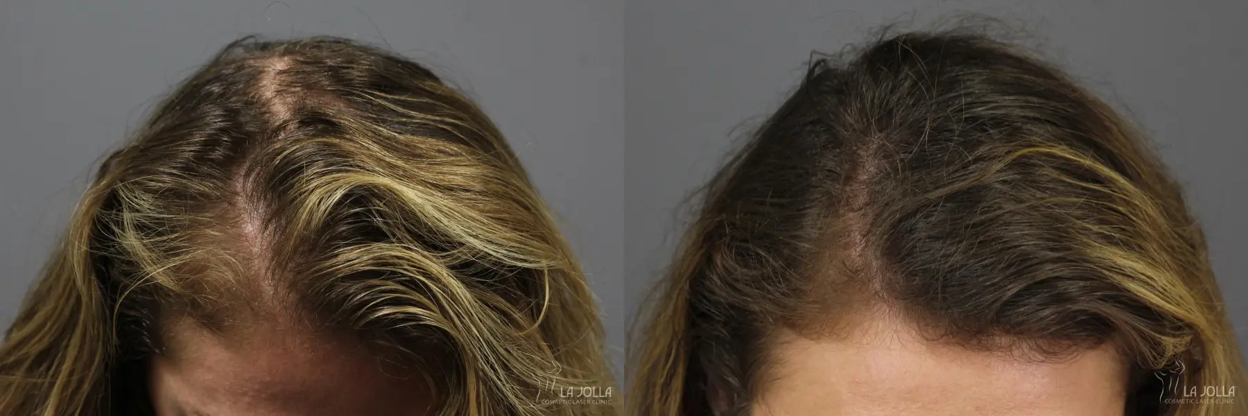 PRP (Platelet-Rich Plasma): Patient 3 - Before and After 1
