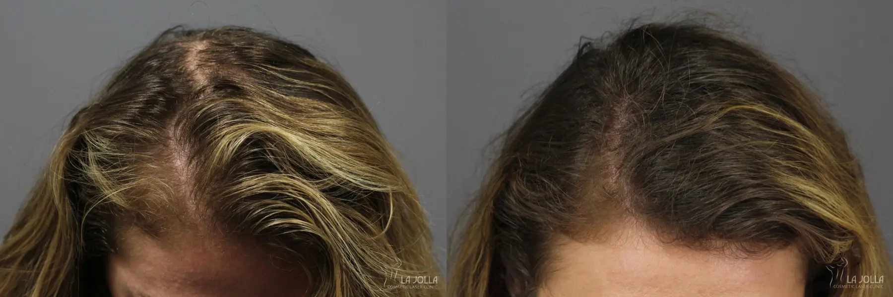 PRP (Platelet-Rich Plasma): Patient 5 - Before and After 1