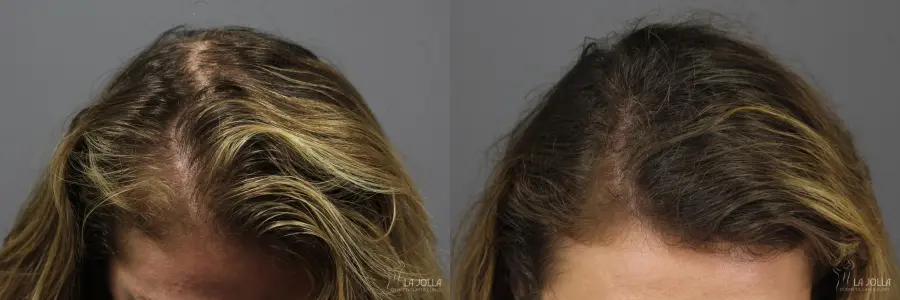 PRP (Platelet-Rich Plasma): Patient 3 - Before and After  