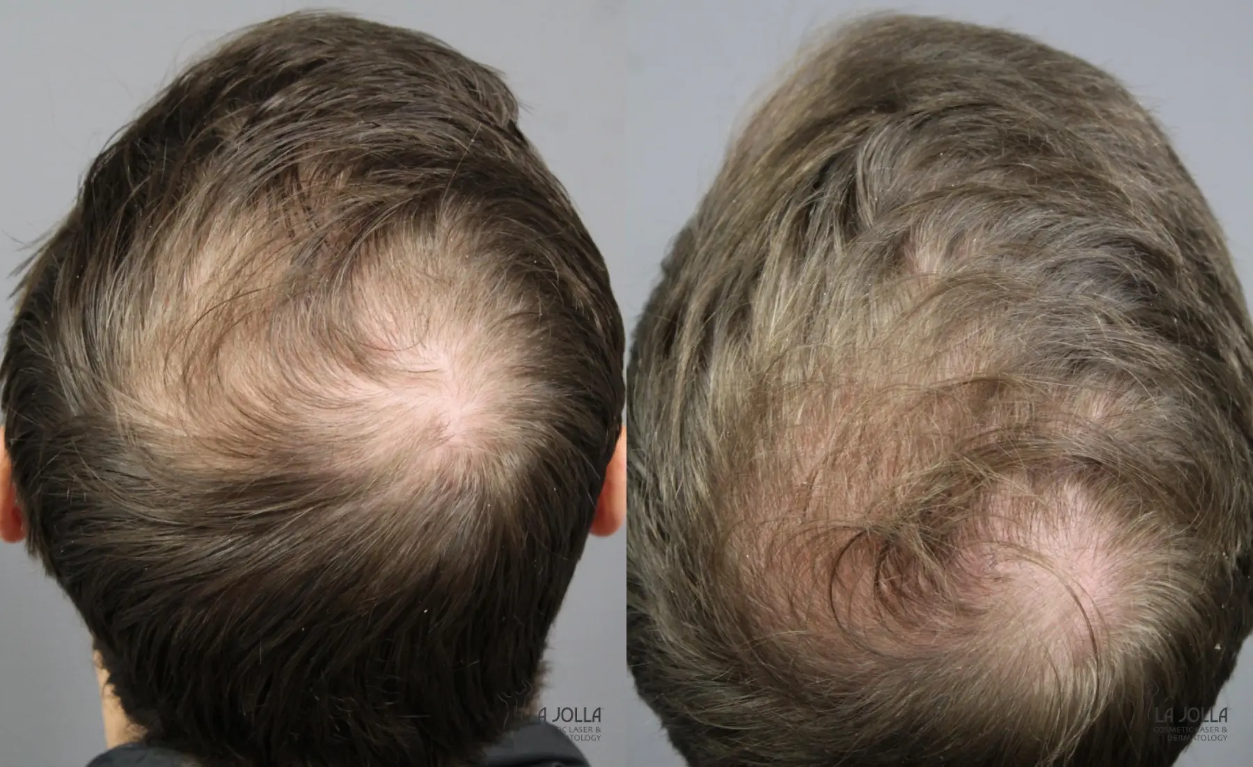 PRP (Platelet-Rich Plasma): Patient 1 - Before and After 2
