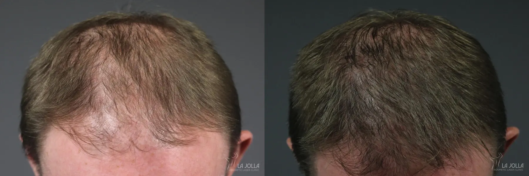 PRP (Platelet-Rich Plasma): Patient 4 - Before and After 1