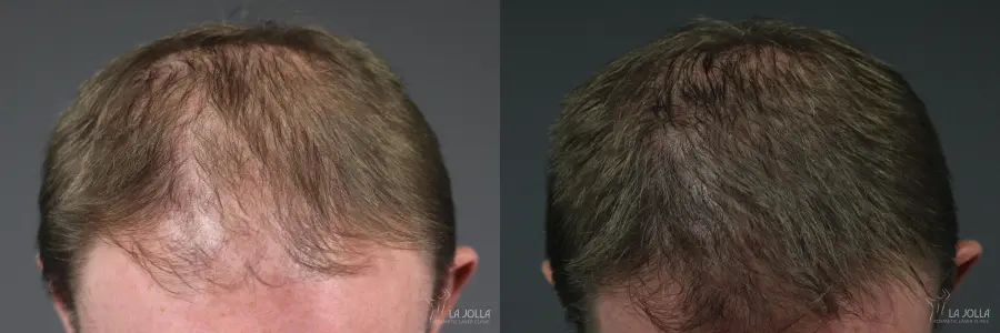 PRP (Platelet-Rich Plasma): Patient 4 - Before and After  