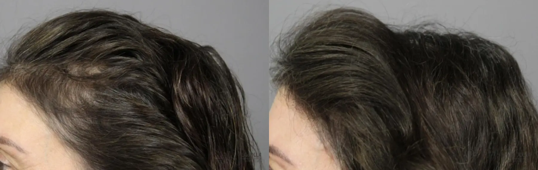PRP (Platelet-Rich Plasma): Patient 3 - Before and After  
