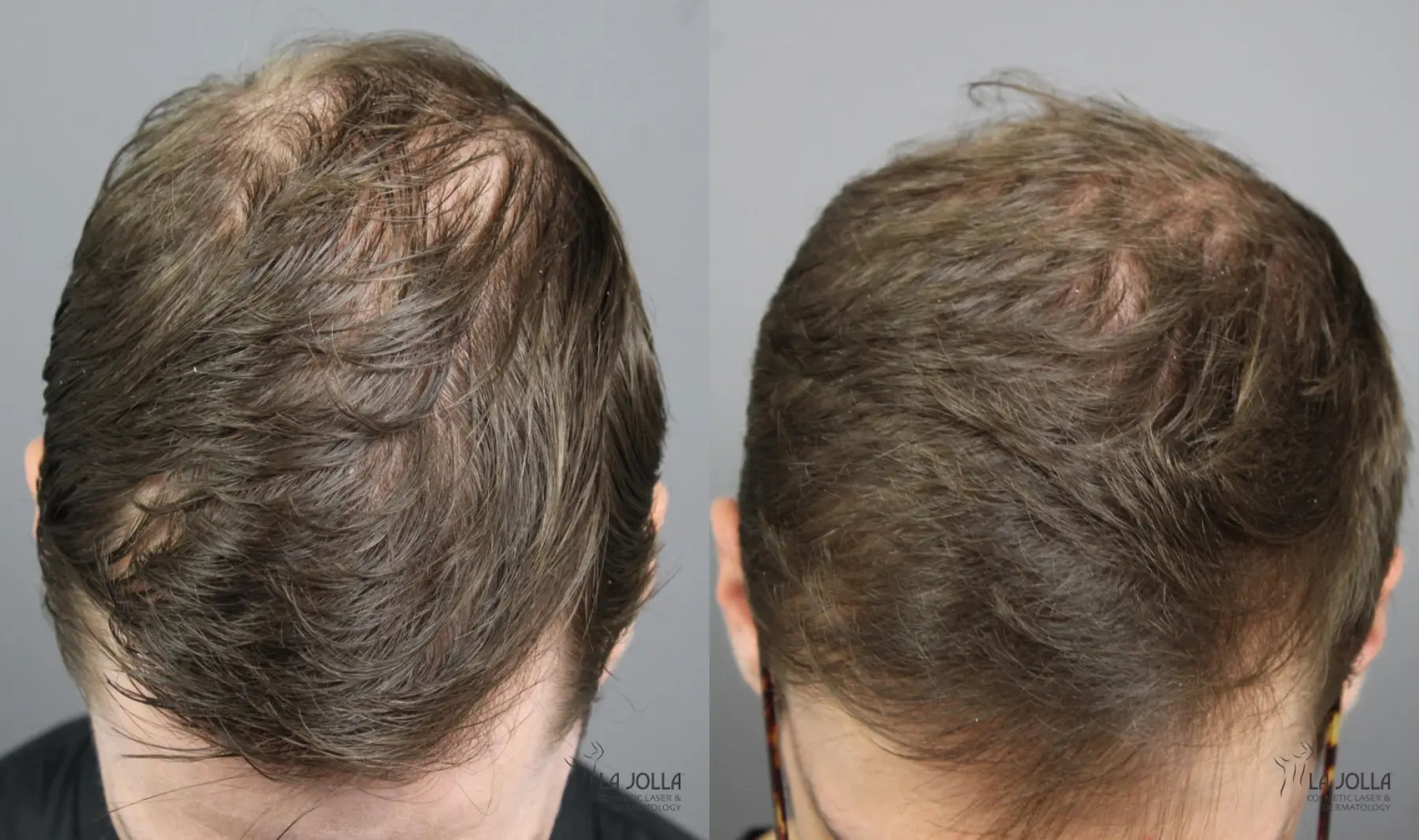 PRP (Platelet-Rich Plasma): Patient 1 - Before and After  