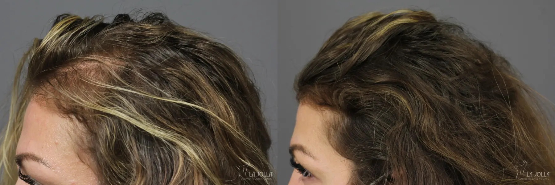 PRP (Platelet-Rich Plasma): Patient 3 - Before and After 2