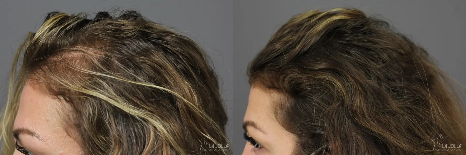 PRP (Platelet-Rich Plasma): Patient 5 - Before and After 2