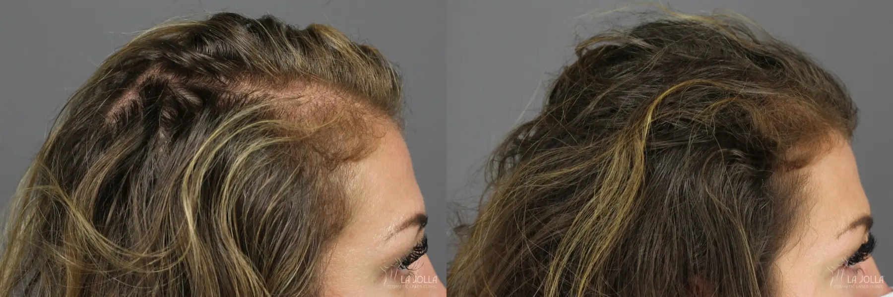 PRP (Platelet-Rich Plasma): Patient 3 - Before and After 3