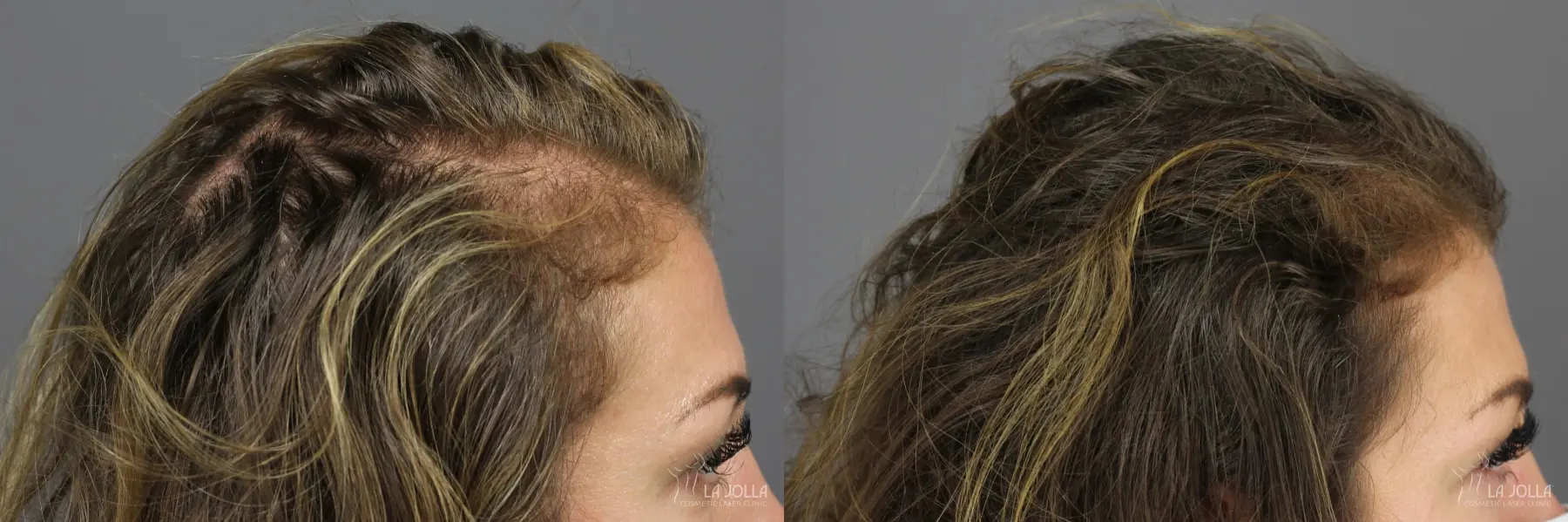PRP (Platelet-Rich Plasma): Patient 5 - Before and After 3