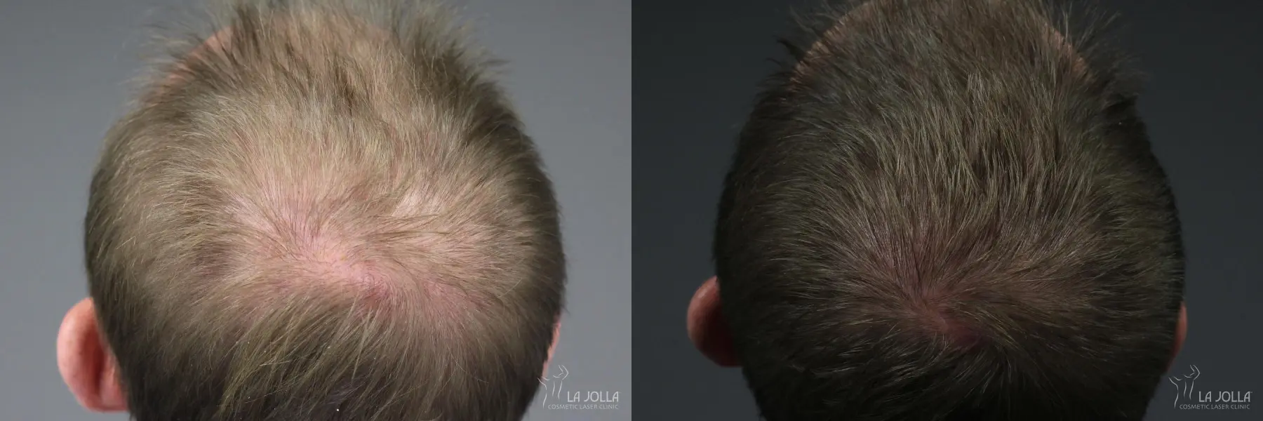 PRP (Platelet-Rich Plasma): Patient 4 - Before and After 2