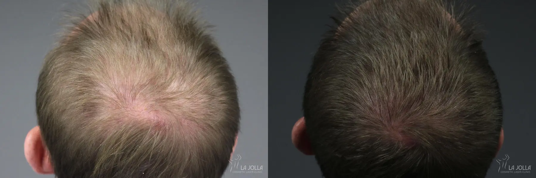 PRP (Platelet-Rich Plasma): Patient 7 - Before and After 2