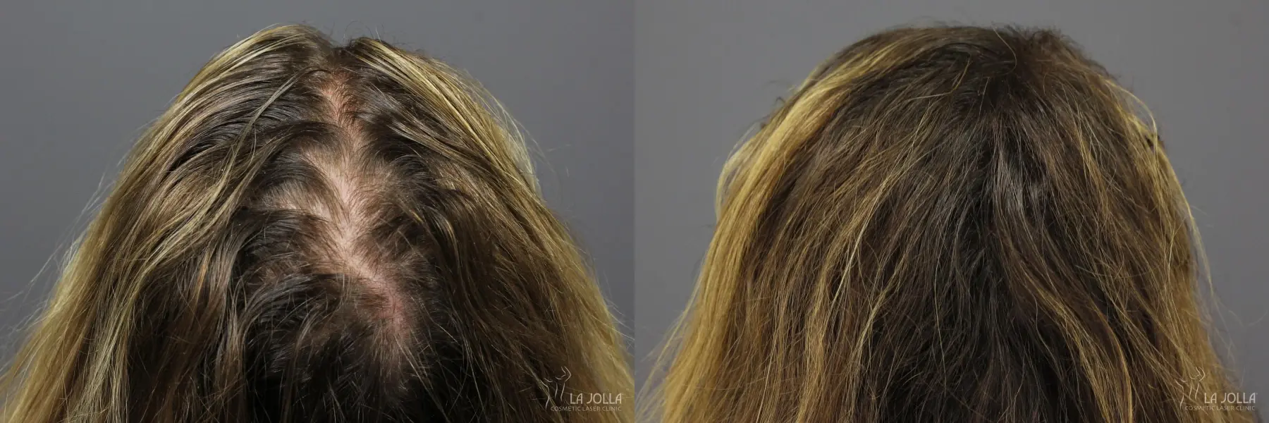 PRP (Platelet-Rich Plasma): Patient 3 - Before and After 4