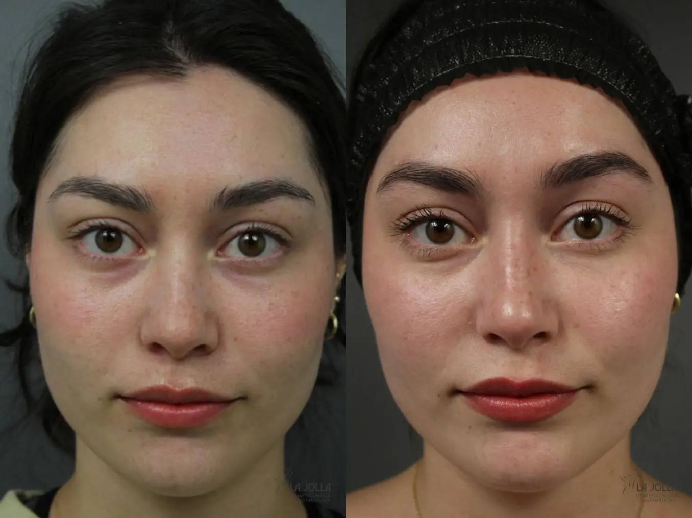 PRP Liquid Facelift: Patient 2 - Before and After  