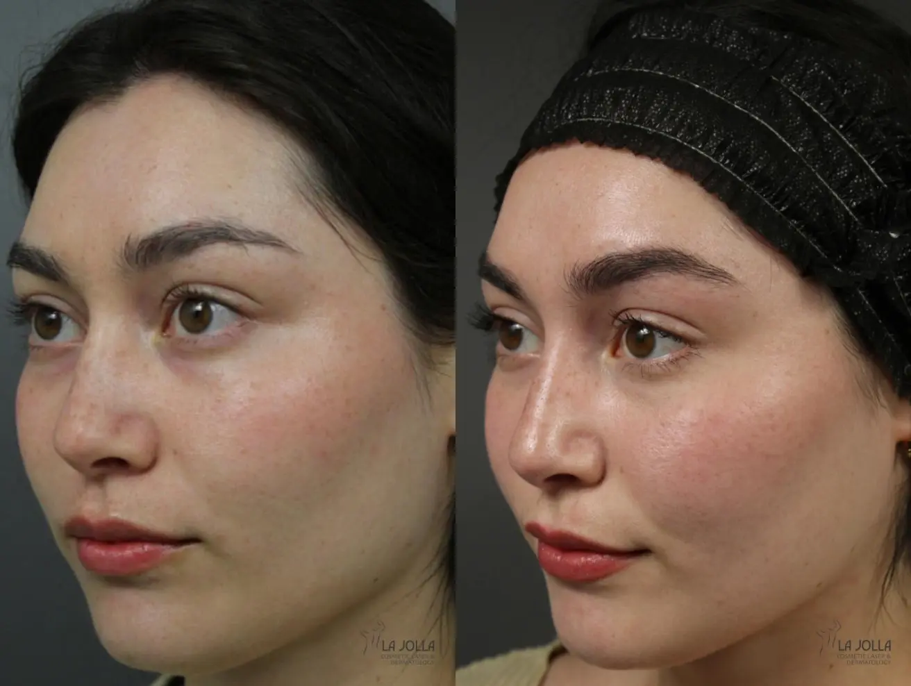 PRP Liquid Facelift: Patient 2 - Before and After 3
