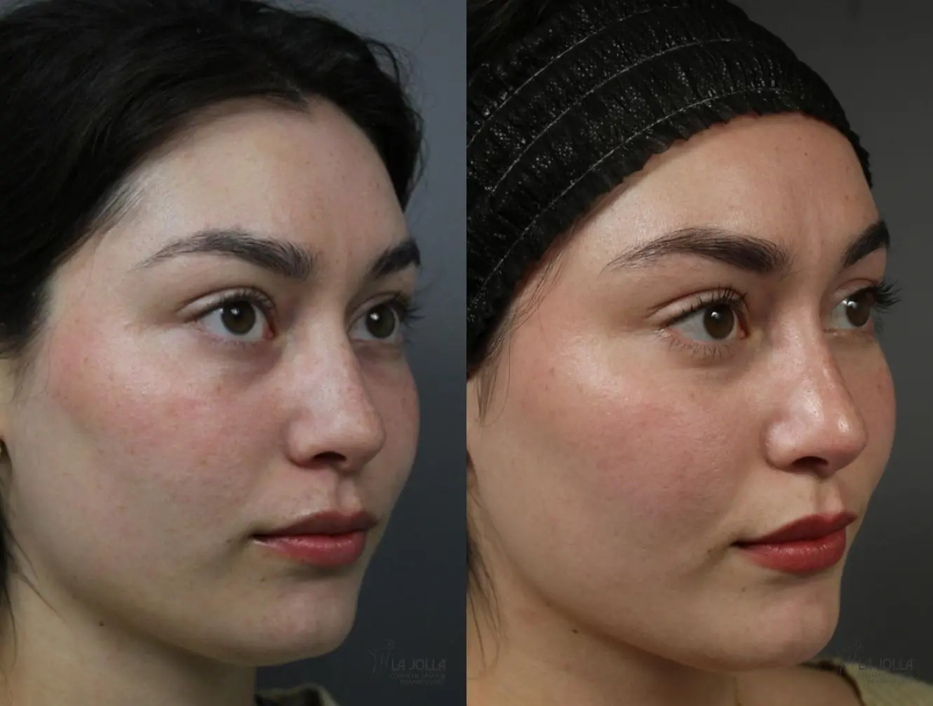 PRP Liquid Facelift: Patient 2 - Before and After 2