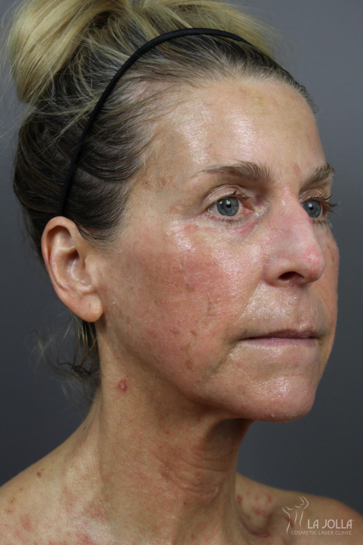 6D Platinum Laser Lift: Patient 3 - After 2