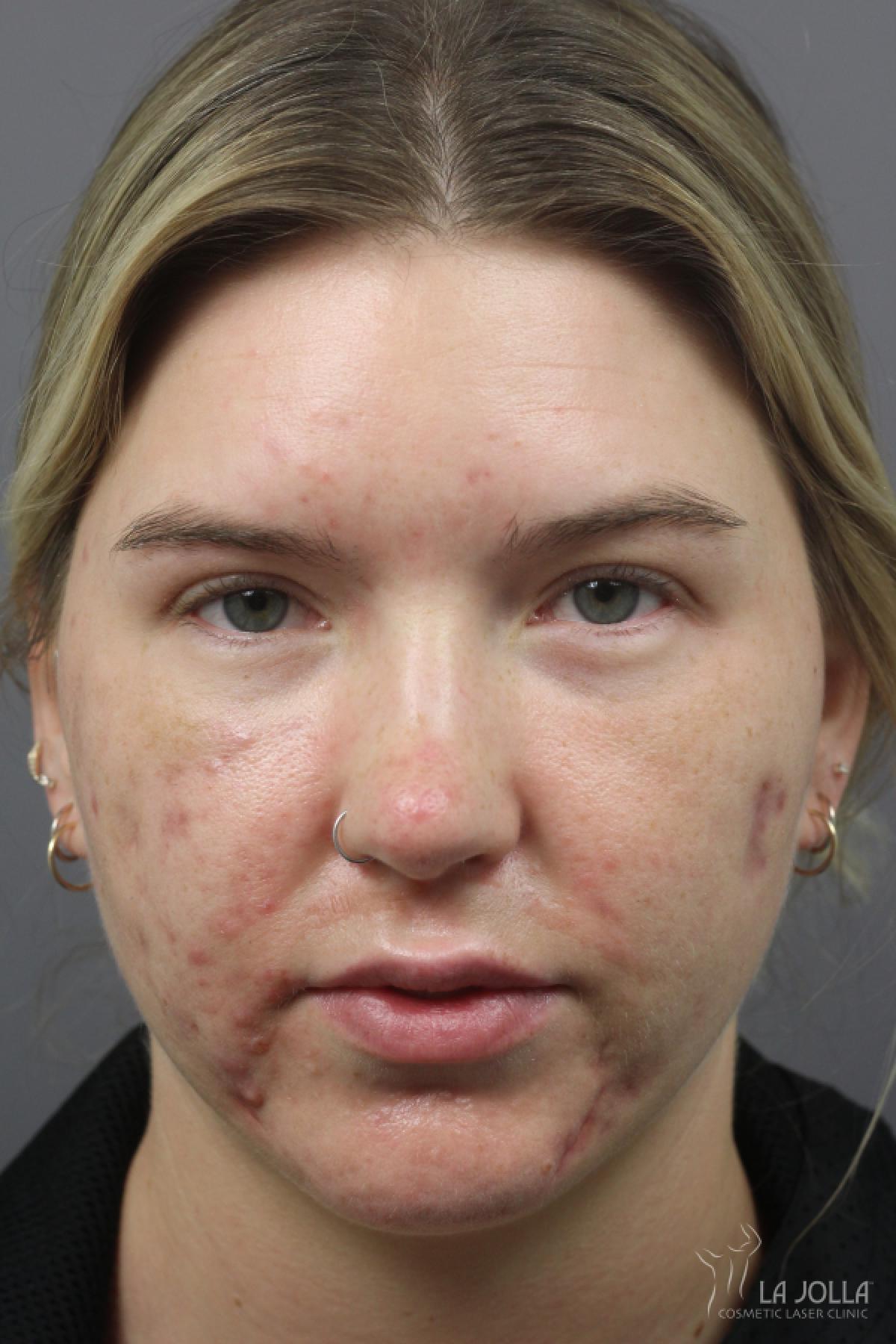 Acne Rejuvenation: Patient 8 - Before 1