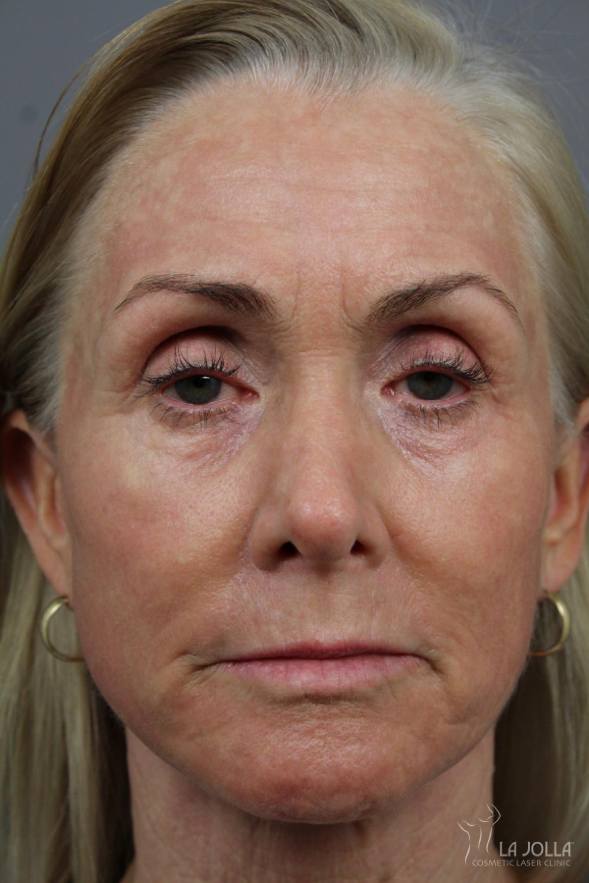 CO2 Laser: Patient 11 - After 1