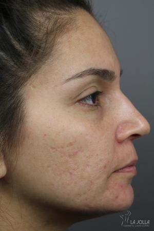 Acne Scars: Patient 3 - Before 