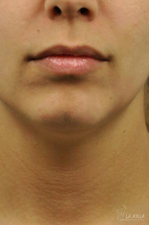 Restylane® Kysse: Patient 2 - Before 