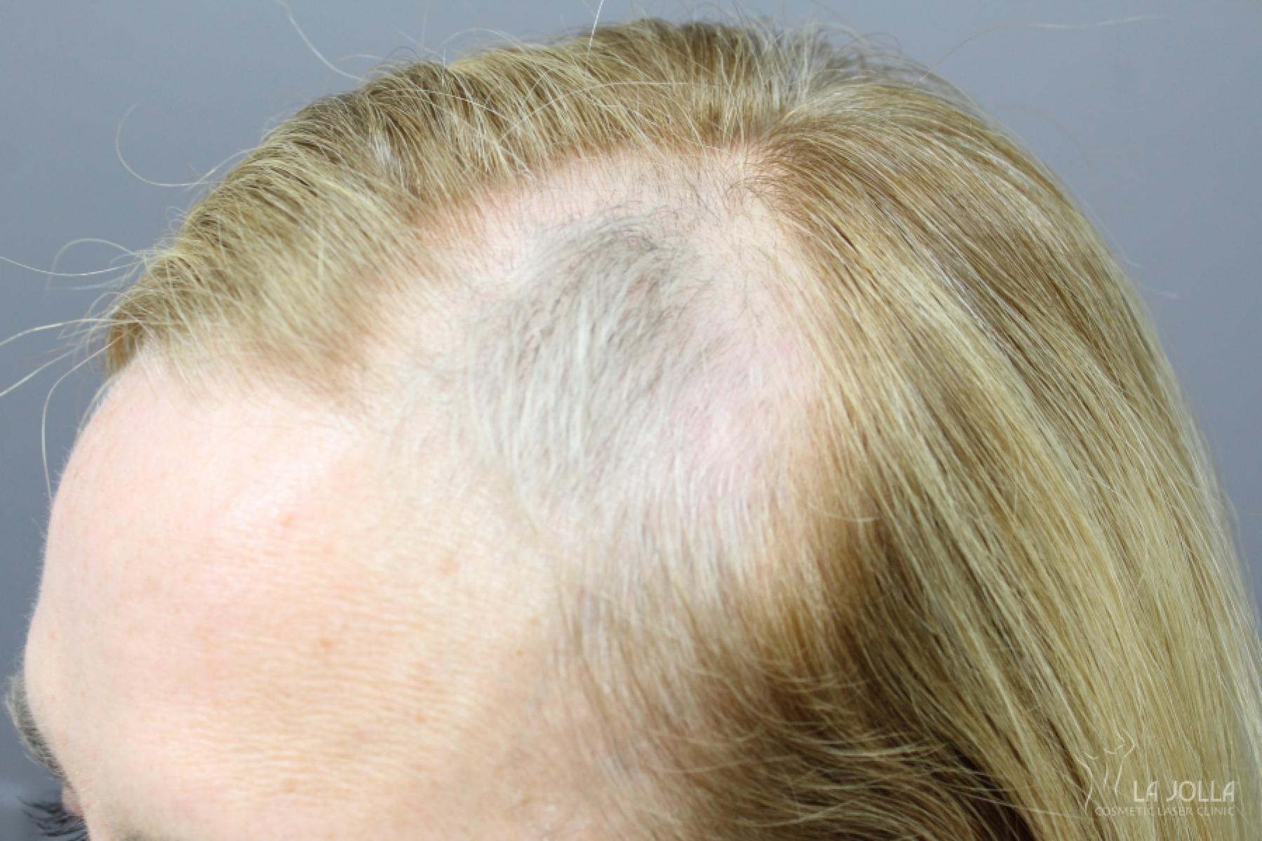 Hair Restoration: Patient 1 - Before 1