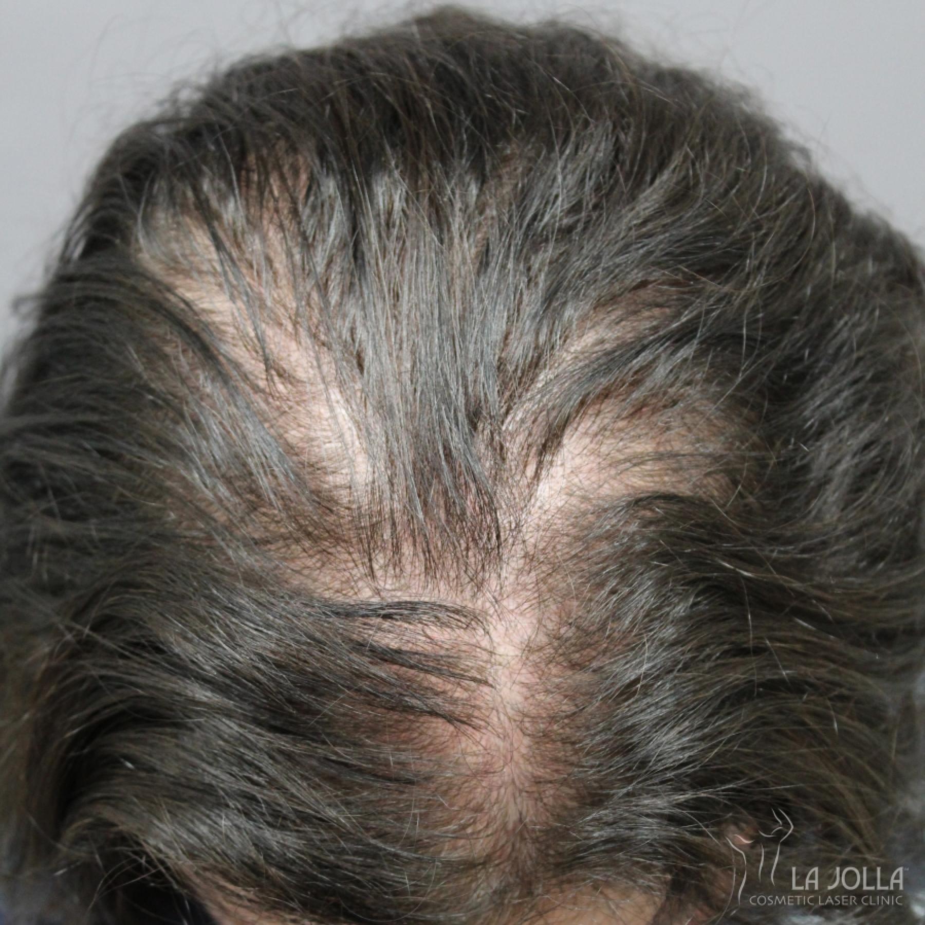 Hair Restoration: Patient 4 - Before 