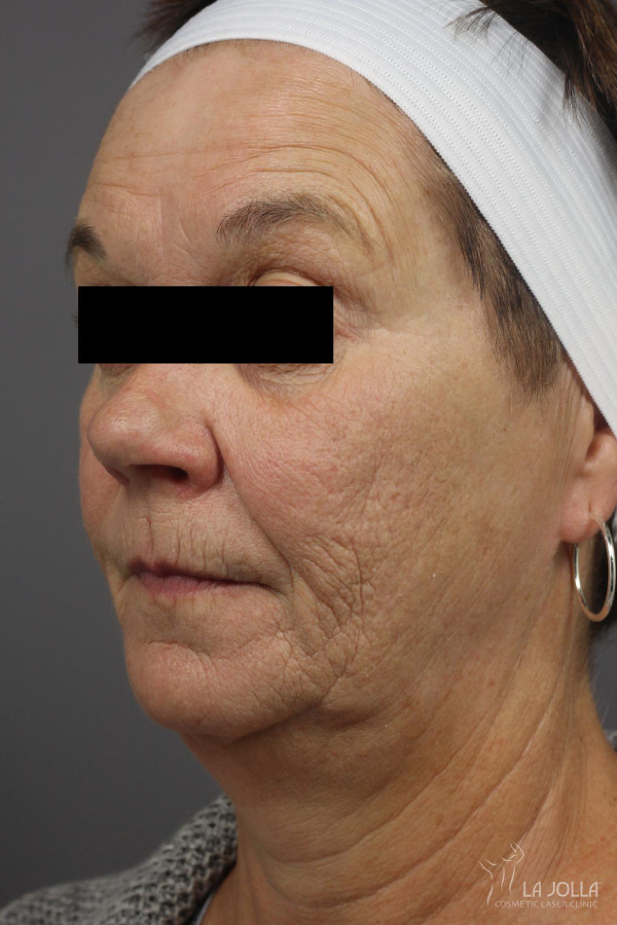 Dermal Fillers Patient 1 Before Procedure