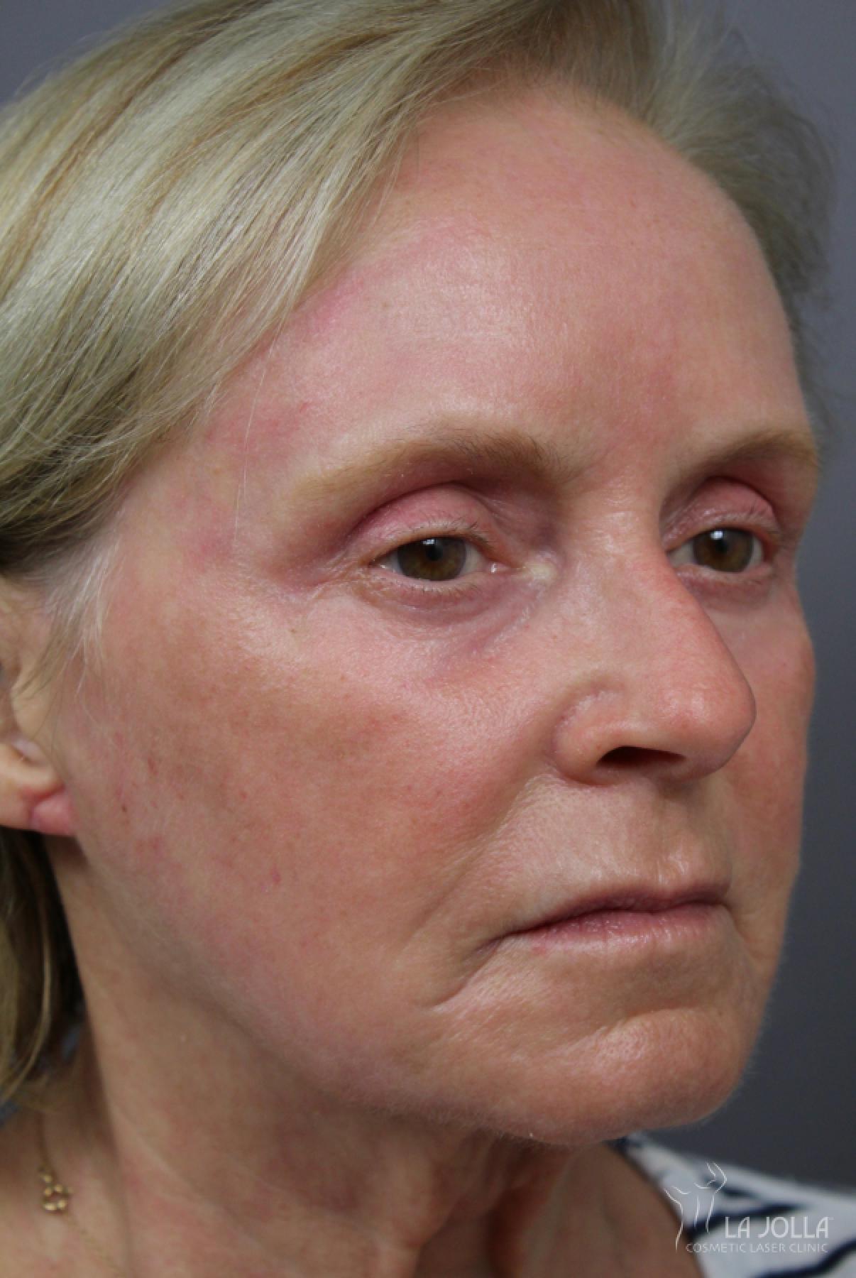 Laser Skin Resurfacing: Patient 2 - After 2