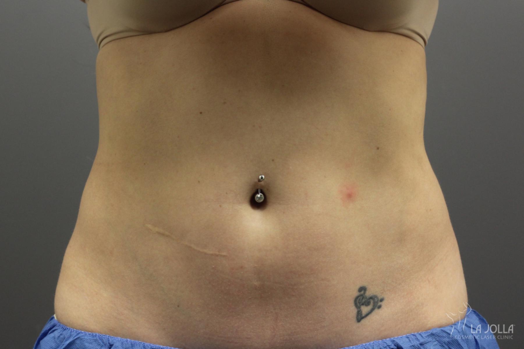 CoolSculpting®: Patient 2 - After 2