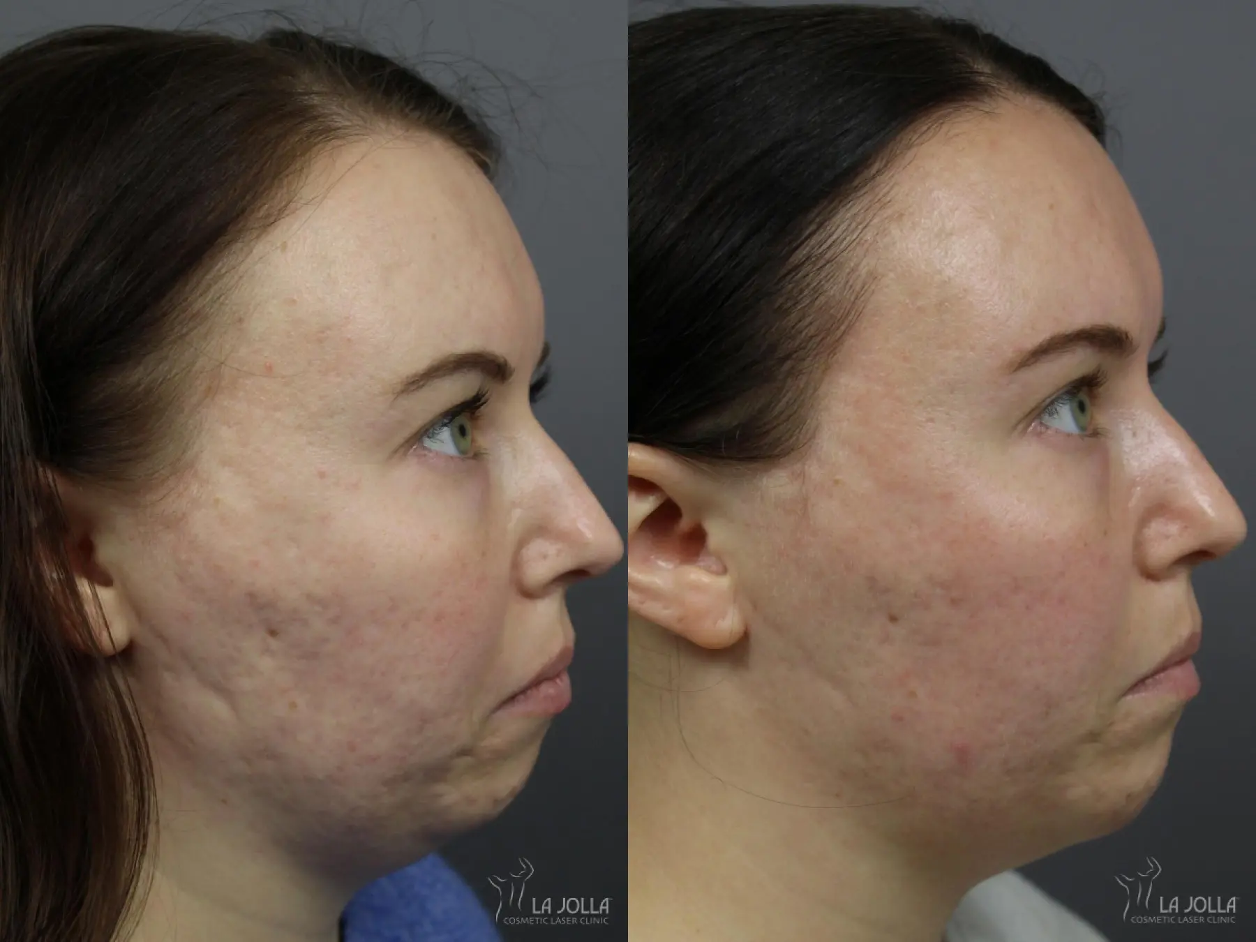 Radiesse®: Patient 1 - Before and After 1